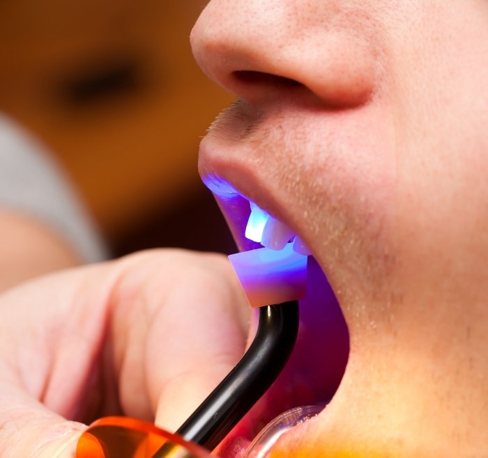 Close up of a dental patient getting bonding on upper front tooth