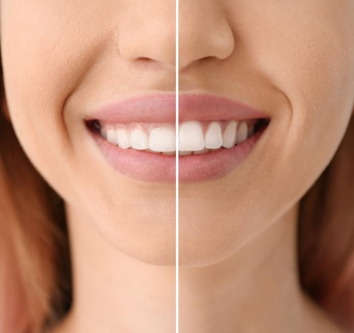 Close up of a woman smiling before and after treating an uneven gumline