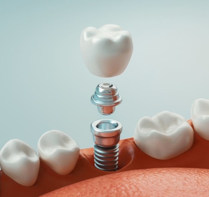 Illustration of a dental implant abutment and crown being placed in the lower jaw