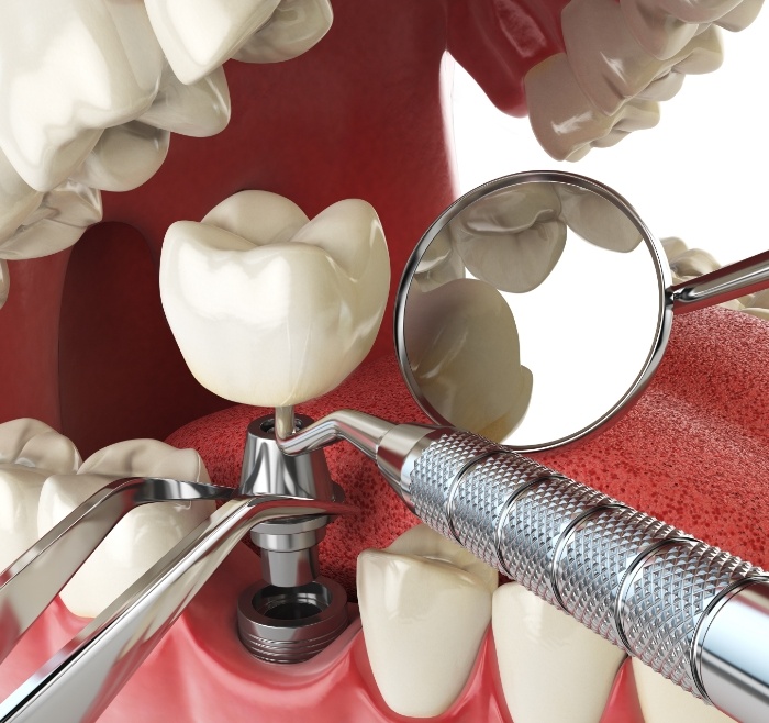 Illustration of a dental implant being placed in the lower jaw