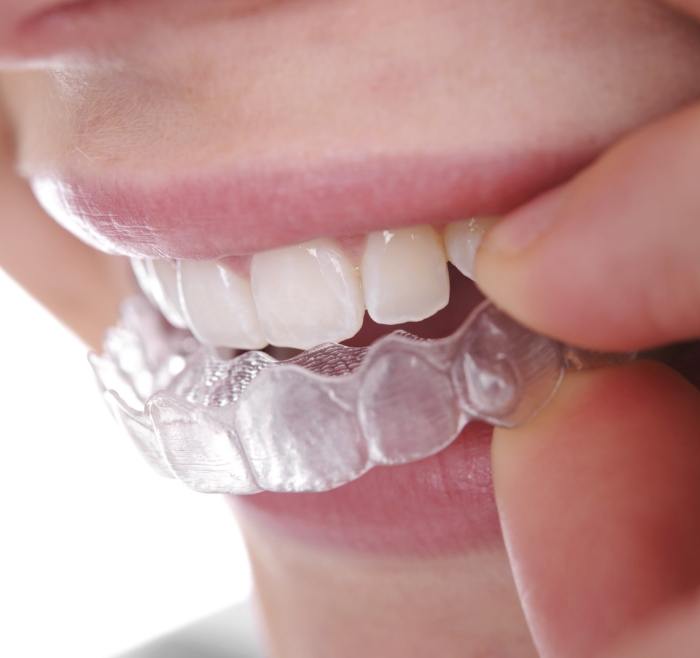 Close up of a person placing a clear aligner over their teeth