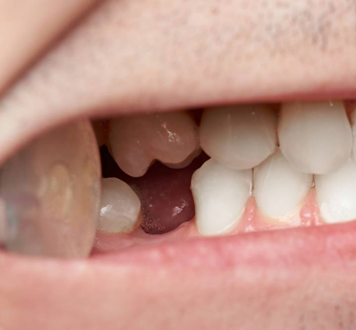 Close up of a smile with one missing lower tooth