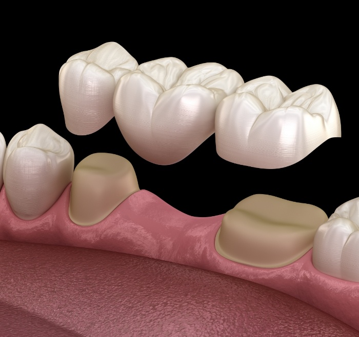 Illustrated dental bridge filling the gap between two natural teeth