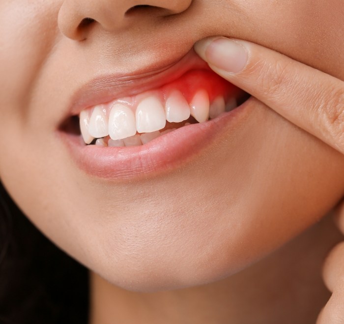 Close up of a person pointing to a red spot in their gums