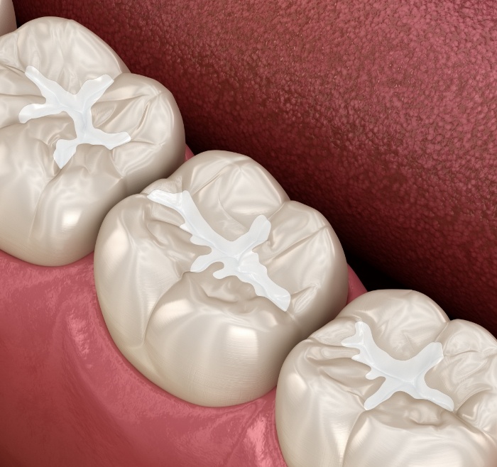 Illustrated row of teeth with dental sealants