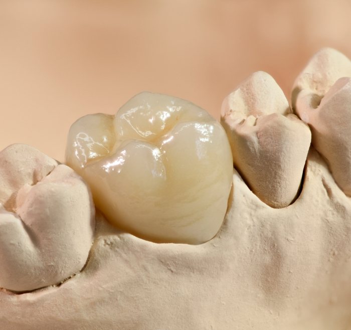 Dental crown covering a tooth in a model of an arch of teeth