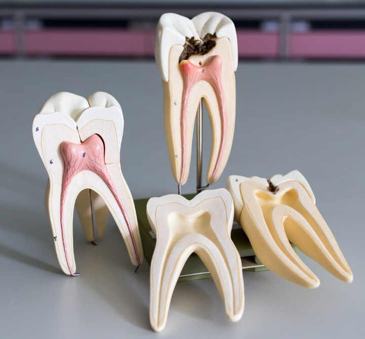 Several models of decayed teeth needing root canal treatment