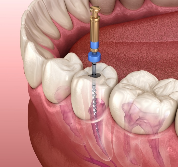 Illustrated dental instrument treating the inside of a tooth