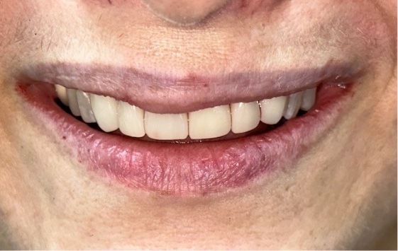 Close up of a smile after whitening and straightening the teeth