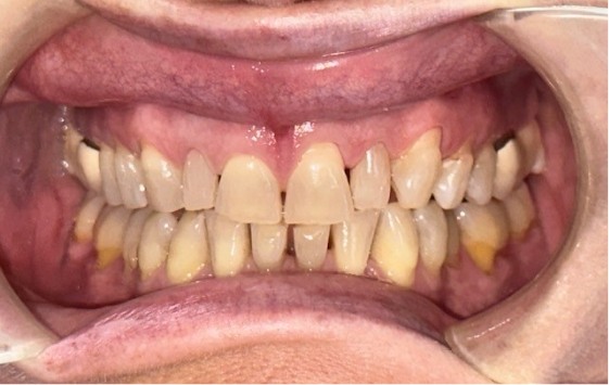 Close up of a smile with discolored and gapped teeth