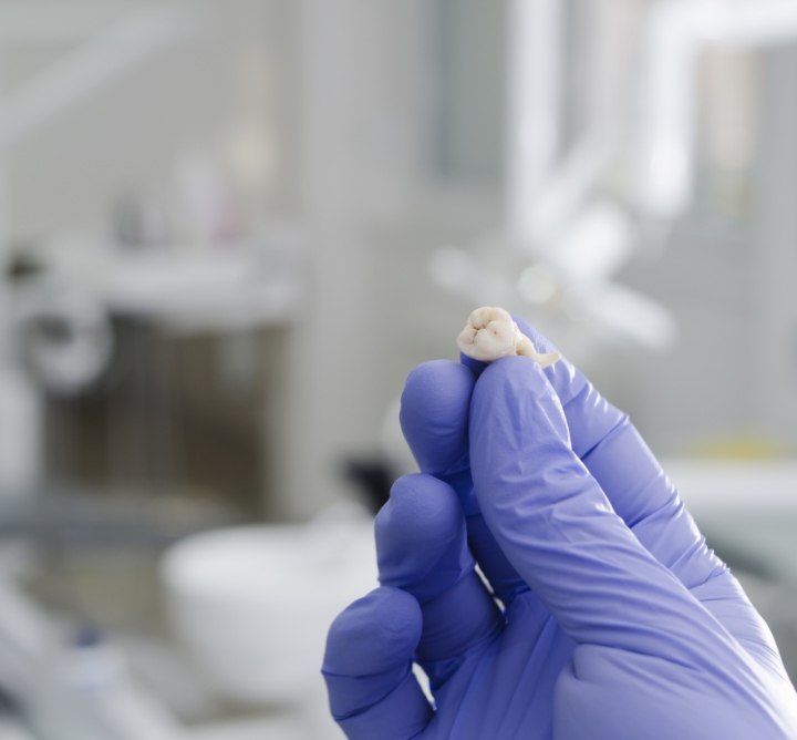 Dentist holding an extracted wisdom tooth in a gloved hand