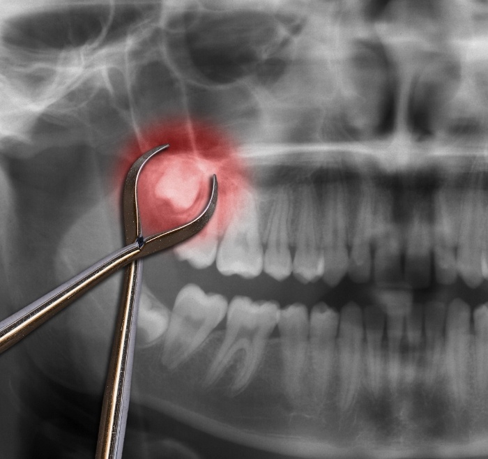 Dental forceps over an x ray showing an impacted wisdom tooth